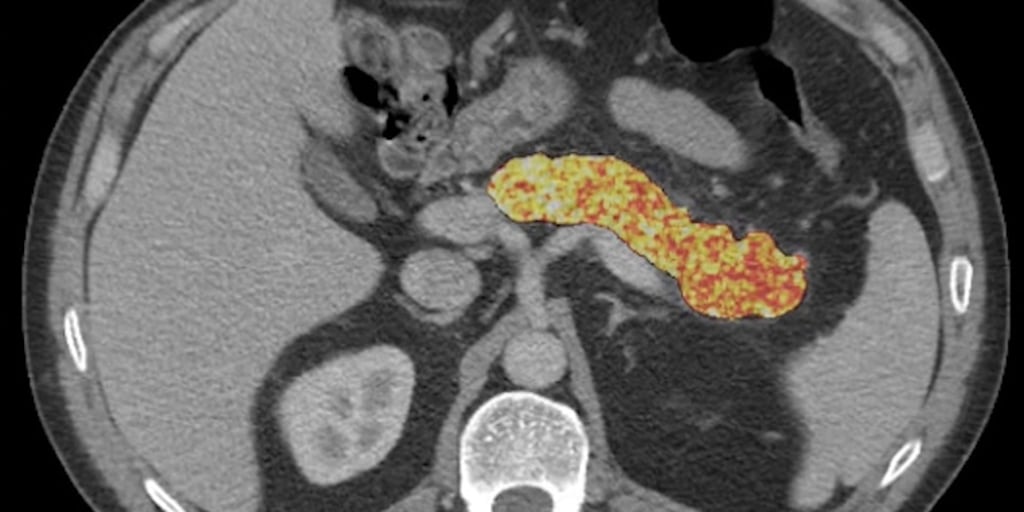 pancreatic cancer early detection - AI Detects Pancreatic Cancer Signs Years Before Tumors Appear