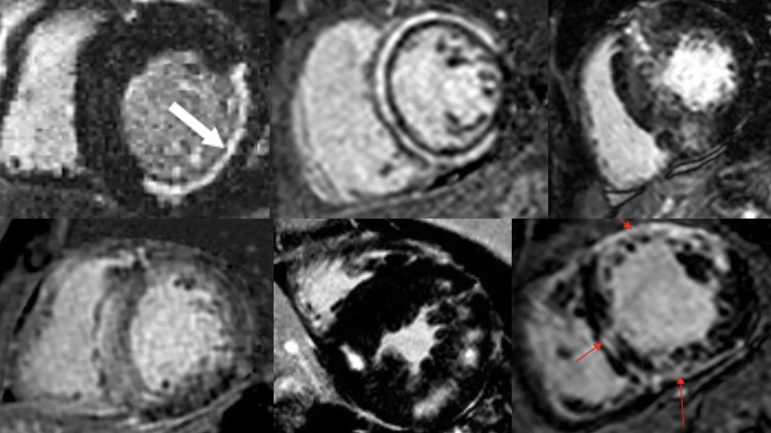 AI cardiac MRI models - How AI Cardiac MRI Models Enhance Diagnostic Accuracy